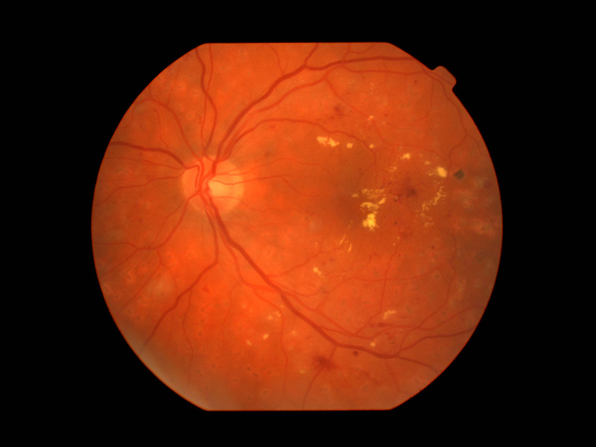 Retinal Disease Classifier - FLAIR vision-language model for diabetic retinopathy and glaucoma detection